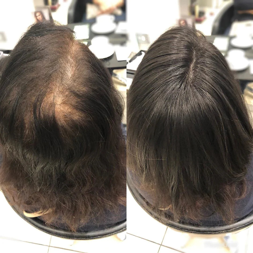 Aplique Topo De Cabeça (Cabelo Humano) - Para Alopecia, Falhas, Cabelos Ralos e com Queda
