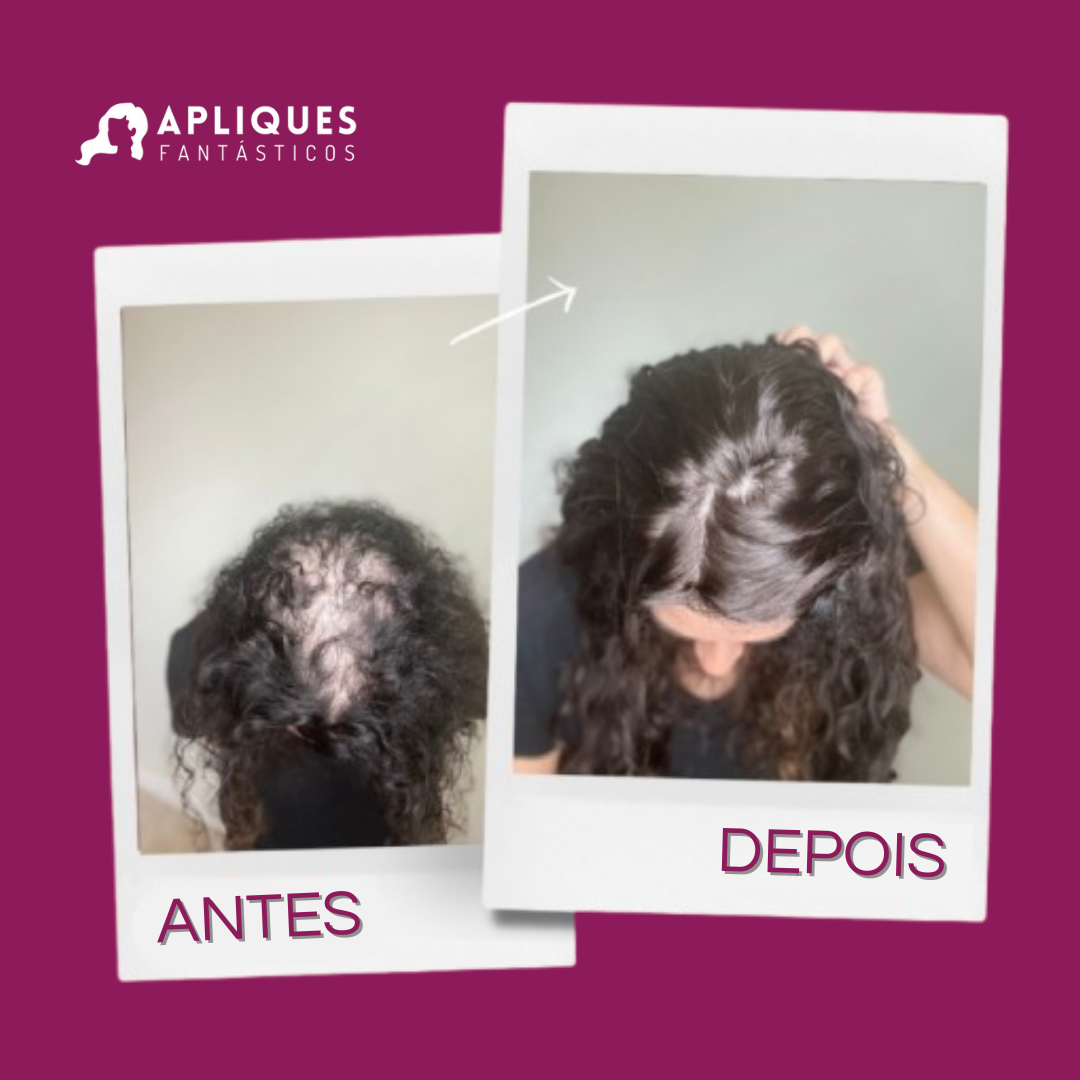 Aplique Topo de Cabeça Cacheado - Fibra Orgânica (Para Alopecia, Falhas, Cabelos Ralos e com Queda)